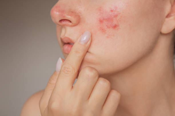 Banish Breakouts: Expert Tips to Clear Acne for Good